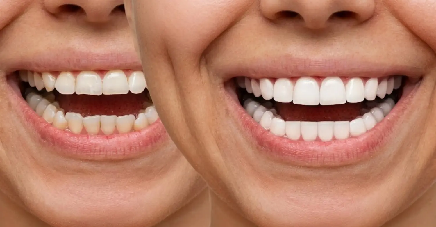 Veneers Turkey 2